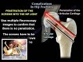 Complications In Hip Fractures  - Everything You Need To Know - Dr. Nabil Ebraheim