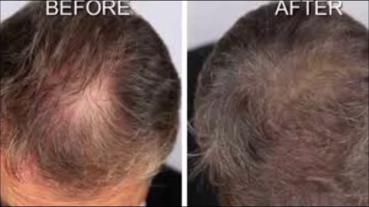 Yoga For Hair Growth On Bald Head Hair Growth Pills For Thin Hair YouTube