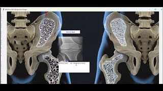 Osteoporosis detection and classification using deep learning algorithm | best project center in ban