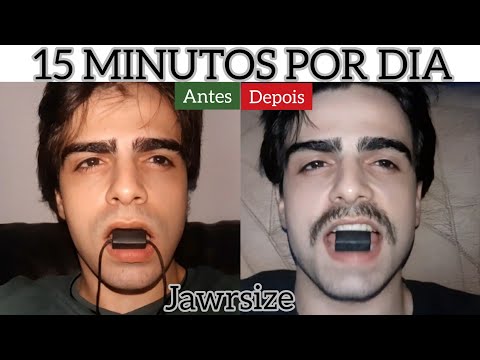 COMO DEFINIR O MAXILAR EM 2 ANOS (JAWRSIZE/ JAW BALL) 