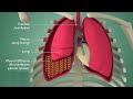 Pleural effusion: Etiology, Clinical Features, Diagnosis, and Treatment  #Usmle Pathology