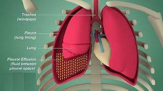 Pleural effusion / Internal medicine: Etiology, Clinical Features, Diagnosis, and Treatment  #Usmle