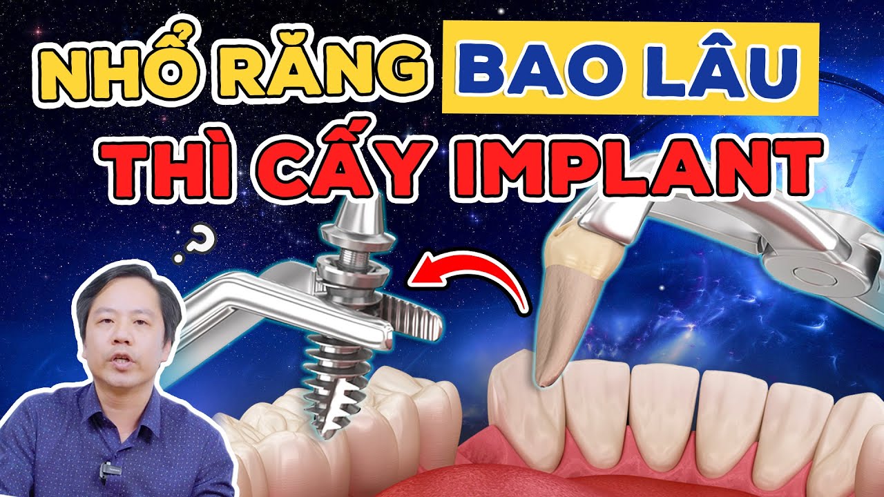 Outline Video Nhổ Răng Bao Lâu Thì Trồng Được Implant? 4 Thời Điểm Chớ Bỏ Lỡ Để Ngăn Tiêu Xương, Cứu Mô Mềm!