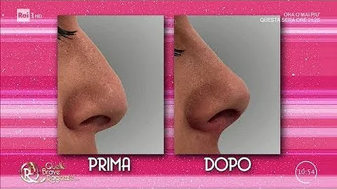 Quanto costa fare il filler al naso?