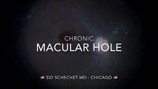 Autologous retinal free flap technique for chronic macular hole - Author: Sid Schechet MD