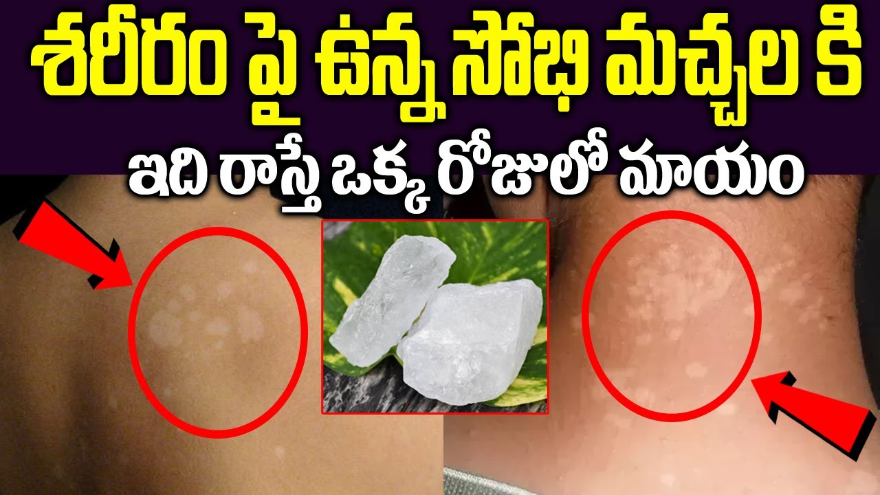 శోభి మచ్చలు ఉన్న చోట ఇది రాస్తే శాశ్వతంగా మటుమాయం | sovhi machhalu | white spots remedies