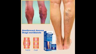 7일 연속 사용하시면 철저히 정맥류와 작별해요.통증을 멀리하고 피부 밑바닥까지 침투하여 핏줄을 제거하고 가려움에서 벗어납니다.