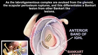 Lesions Of The Shoulder Bankart Lesion - Everything You Need To Know - Dr. Nabil Ebraheim