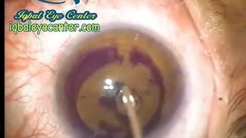 INTACS Implantation in the Cornea Using the Manual Technique in Keratoconus