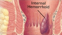 How to Cure Internal Hemorrhoids