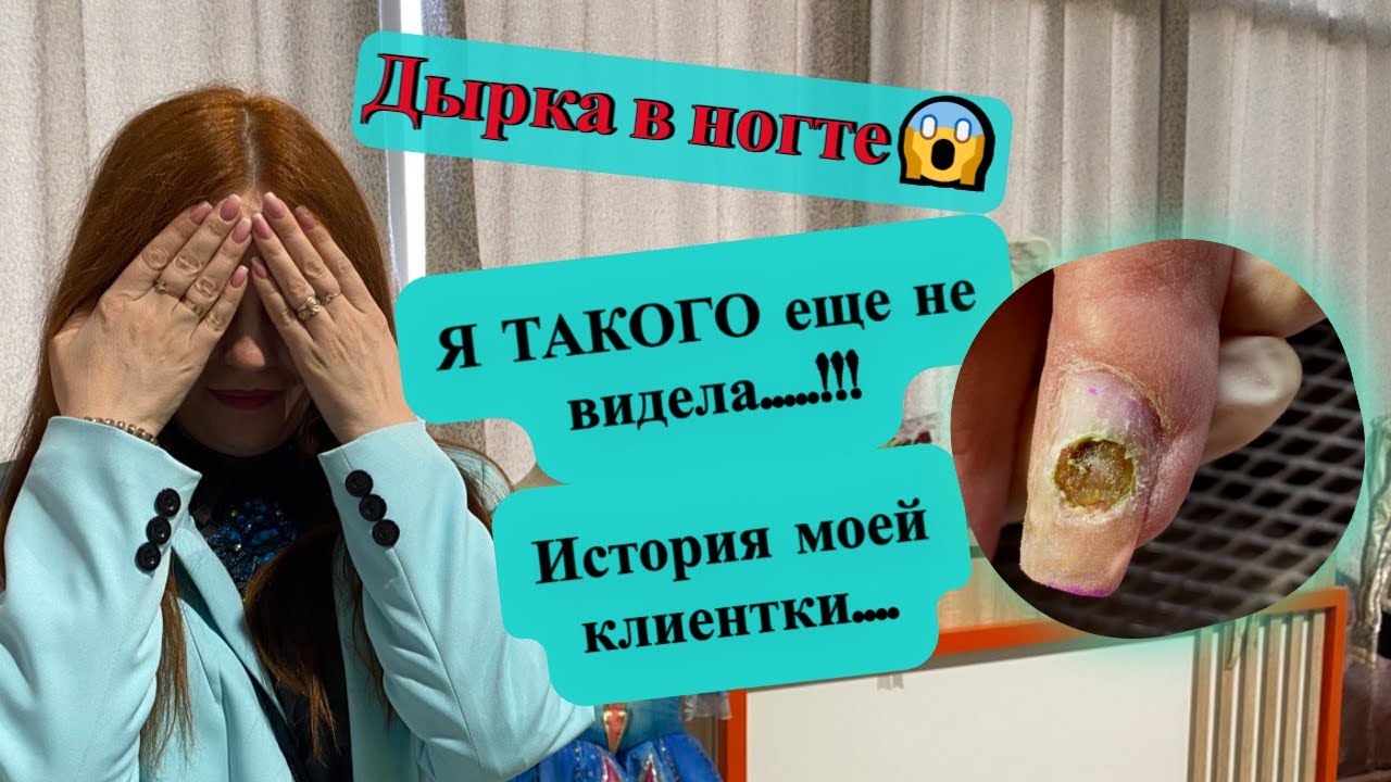 Дырка в ногте!Синегнойка!Трэш-маникюр! - YouTube