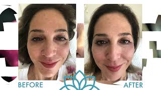 Bio-Filler Prime Treatment | CARE Esthetics