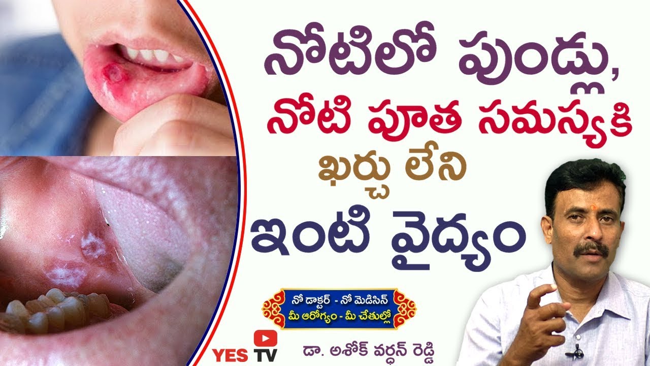 నోటిలో పుండ్లు, నోటి పూతతో బాధ పడేవారికి చక్కని ఖర్చులేని ఇంటి వైద్యం YES TV