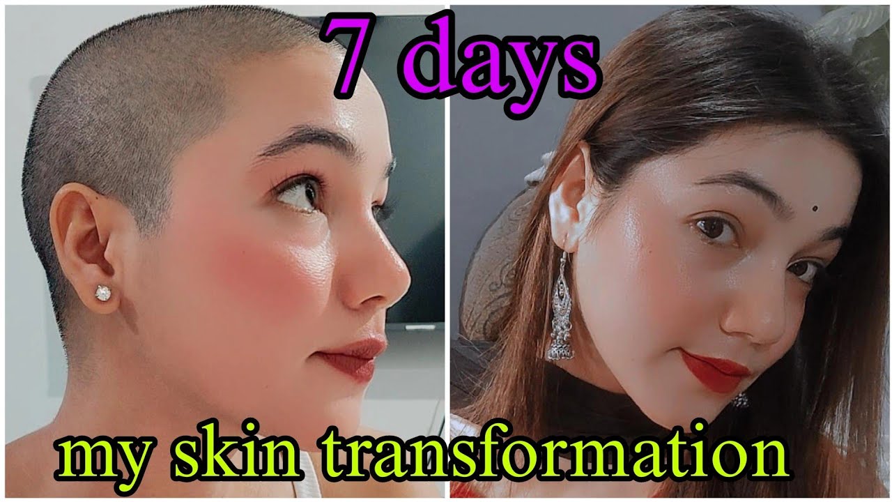 MY Skin Transformation Challenge Remove Open Pores Blackhead Whitehead