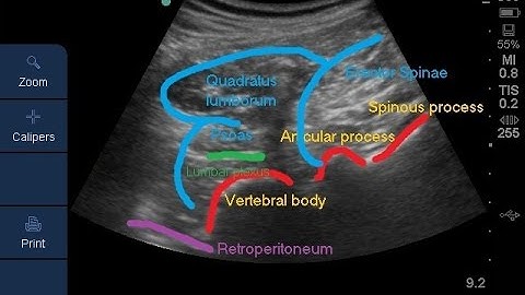 Lumbar plexus block- Description of all approaches