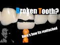 Broken Tooth Reattachment Using Veneer Cement and Air Particle Abrasion