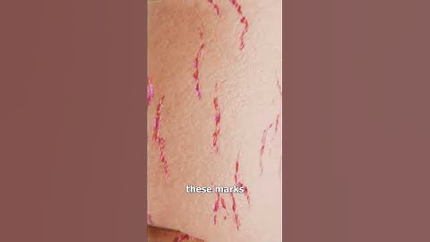 How Stretch Marks Appear 😮