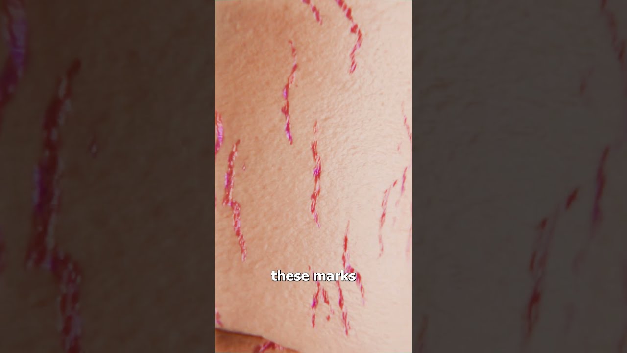 How Stretch Marks Appear 