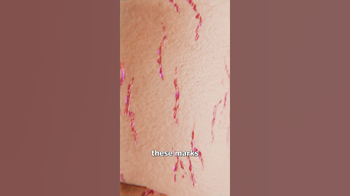 How Stretch Marks Appear 😮