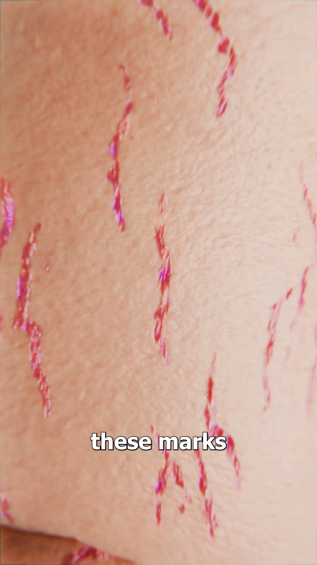 How Stretch Marks Appear ?