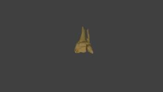 Malunited tibia and fibula 3D reconstruction 360 video