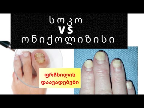 ფრჩხილის დაავადებები / სოკო VS ონიქოლიზისი