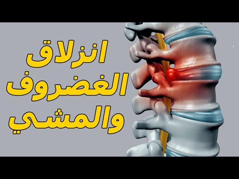 فيديو: بالكاد يستطيع المشي عرق النسا؟