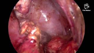 Laparoscopic Appendectomy obstructed with aFecolith استئصال الزائدة الدودية بالمنظار بها التهاب شديد