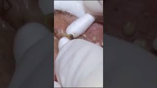 73 blackheads blackhead removal blackhead extraction  youtubeshorts