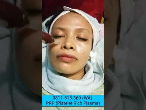 0811-513-369-(wa)-cara-menghilangkan-bopeng-di-wajah-dan-membuat-wajah-glowing-di-batulicin-simpang