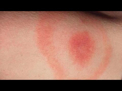 ظهور بقع حمراء على الجلد عند الأطفال Youtube