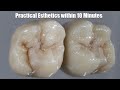 How to Create Practical, Simple Esthetics for Maxillary Molars | Dental Lab Education