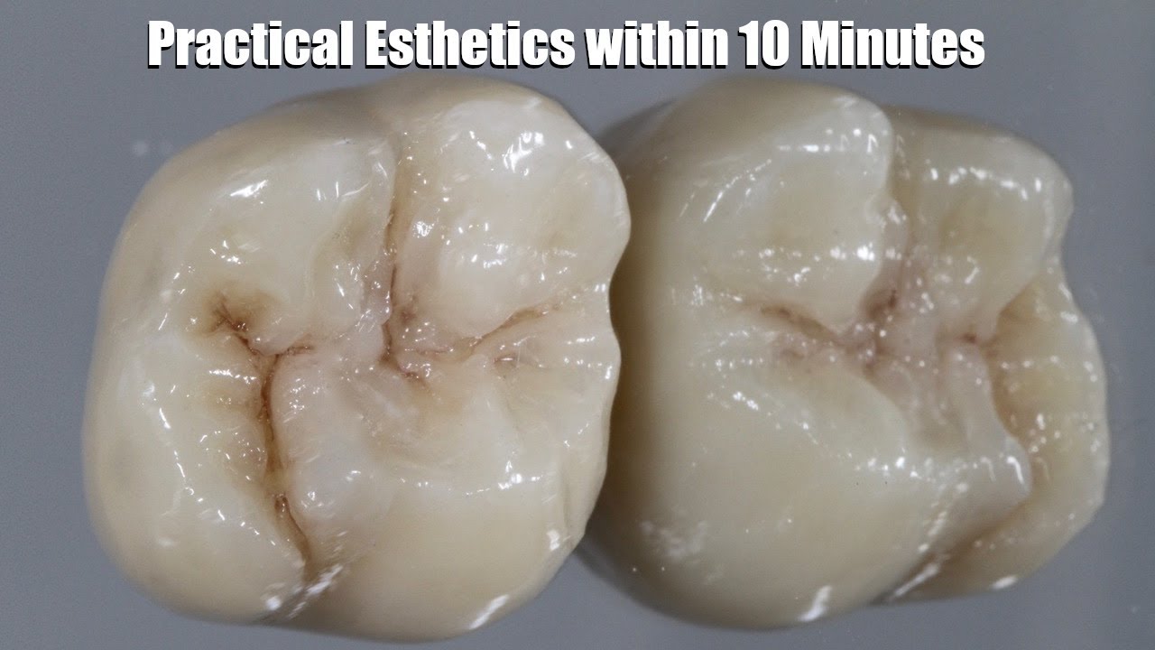 How to Create Practical, Simple Esthetics for Maxillary Molars | Dental Lab Education