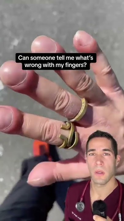 what-are-clubbed-fingers-doctor-medical-fingers-medicineexplained