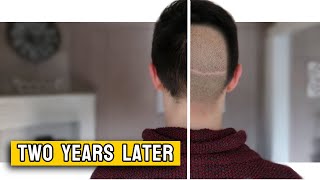 How does my Donor Area look after a Hair Transplant?