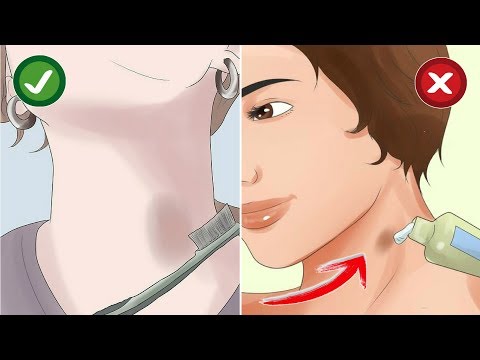 Vídeo: ¿Cuánto Duran Los Hickeys? Además, Qué Puede Hacer Para Deshacerse De Ellos