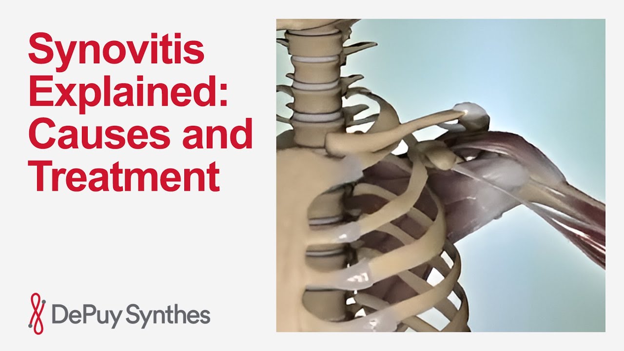 Synovitis of the Shoulder: Symptoms, Causes, and Treatment Options | DePuy Synthes