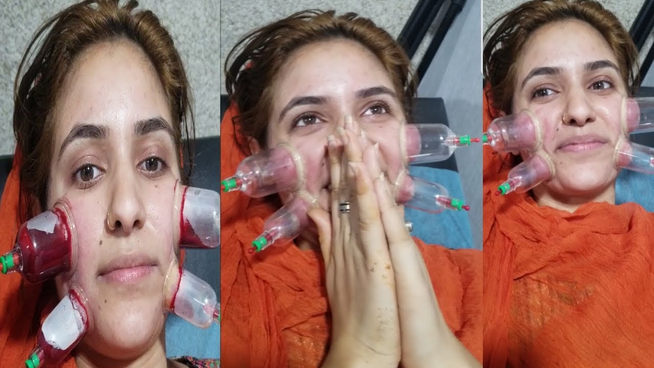 ACNE AND PIMPLES CURE WITH HIJAMAH/CUPPING THERAPY YouTube