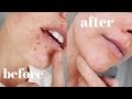 I Drank Tea For 30 Days To Clear My ACNE | Before & After