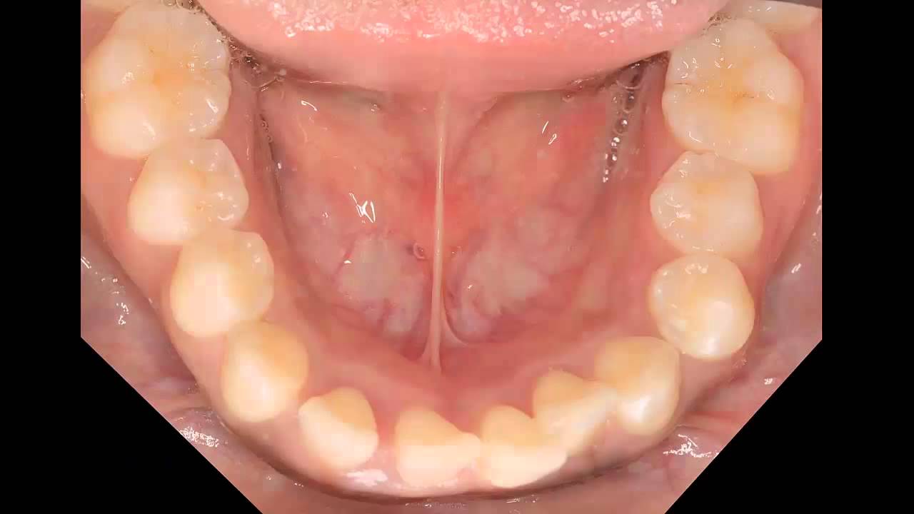 Aggressive periodontitis - YouTube