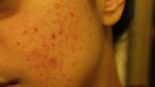 **open me for information** watch in hdthreading disaster, acne
breakouts, so threading has caused and a ton load of redness! here is
my story!lets be f...