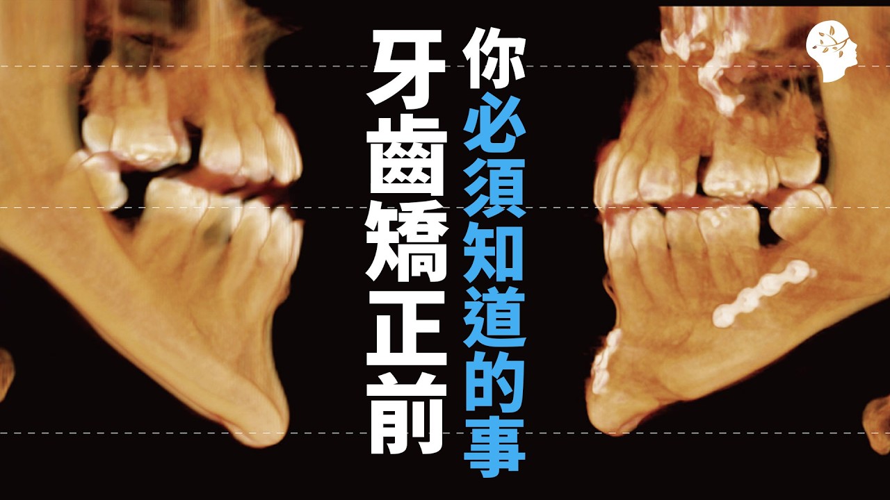 牙齒矯正前一定要看(不看可能悔恨終身)