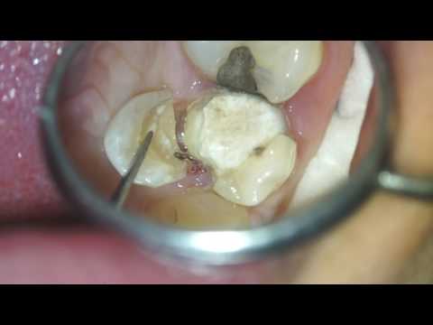 Zlomljen zdravljen zob - Mikrozobozdravstvo Zvezda