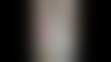 Infected non union Tibia with exposed bone and implant