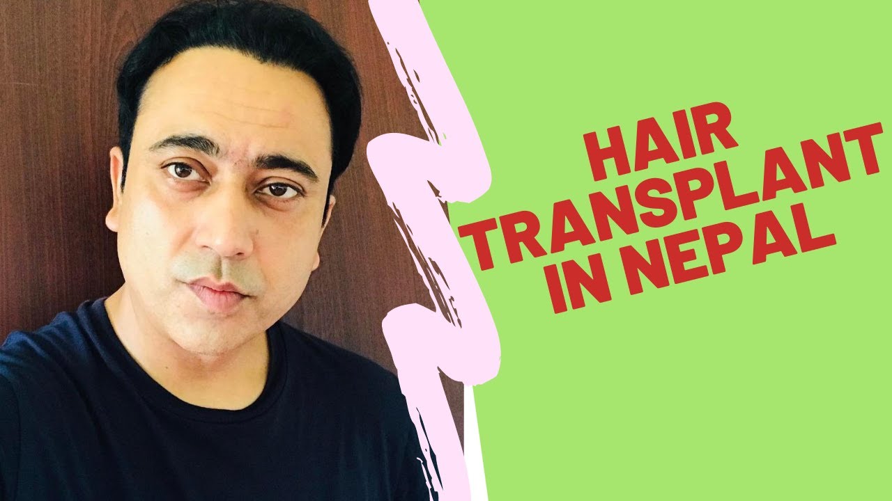 hair transplant in nepal 8 months results YouTube