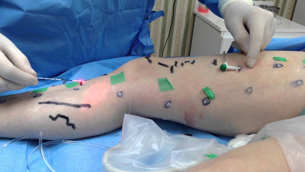 Sensación de hormigueo entumecido en las piernas
