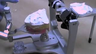 26 Mount Maxillary Cast