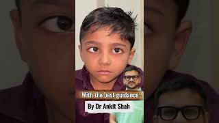 Crossed Eyes in Children Corrected with Glasses | Accommodative Esotropia Success Story