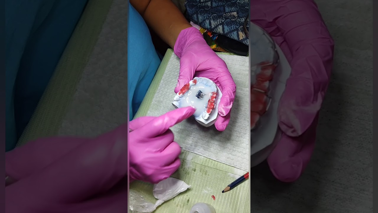 PASOS PARA REALIZAR UNA PLACA HAWLEY CON TORNILLO DE EXPANSIÓN CENTRAL .