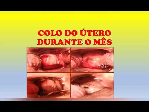 Vídeo: Edema Antes Da Menstruação: Como Lutar, Motivos, Quantos Dias Leva